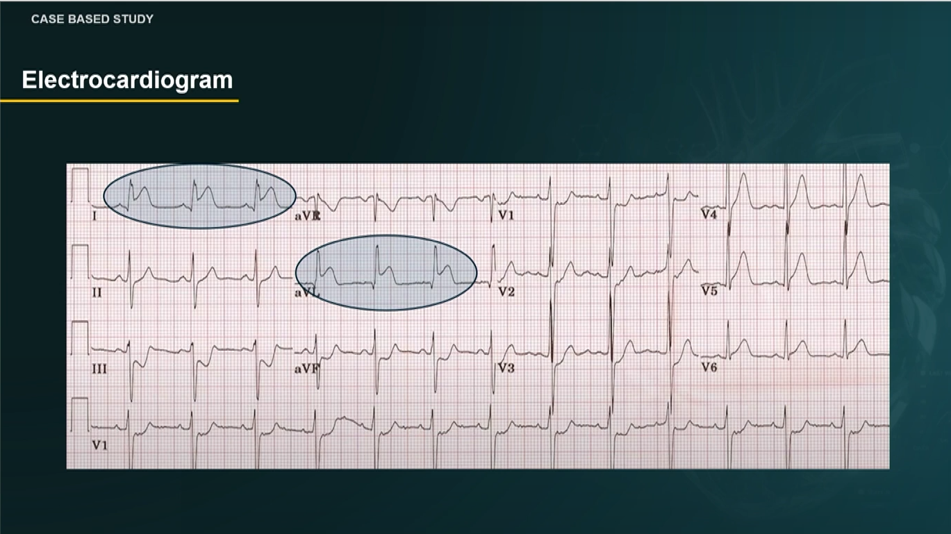 When you think that STEMI is all about primary PCI