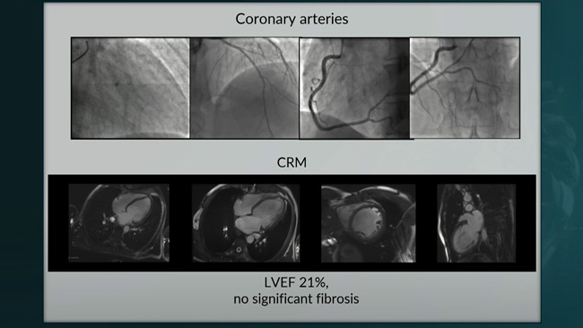 New onset of heart failure and reduced ventricular ejection fraction - A clinical case
