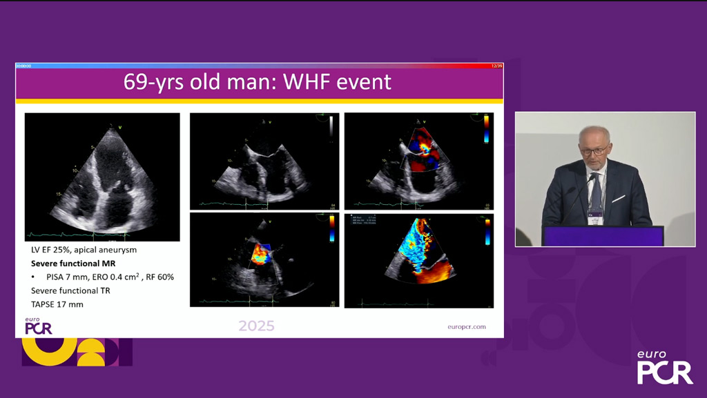  Refractory heart failure: combining oral therapy and device is key
