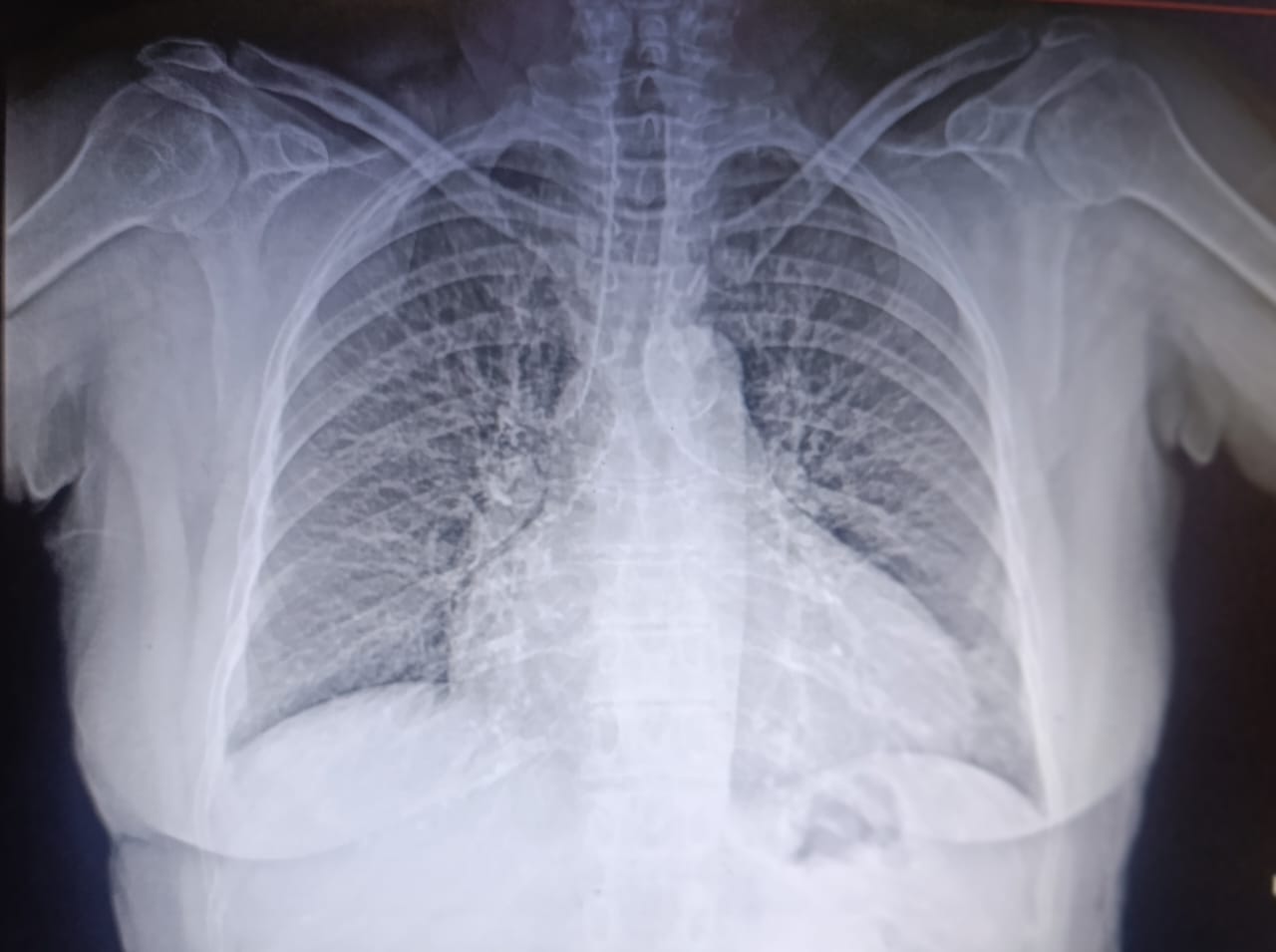 Acute decompensated Heart Failureꓽ  should the focus be solely on the heart?