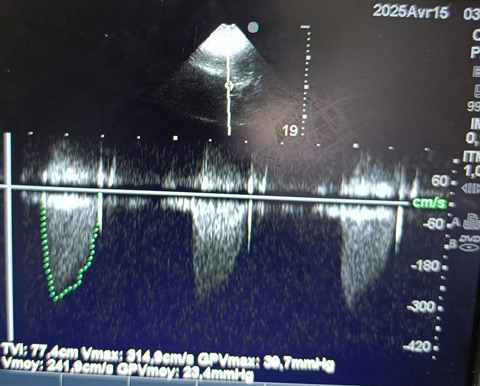 Continuous-wave Doppler of the aortic valve showing a mean pressure gradient of 23.4 mmHg