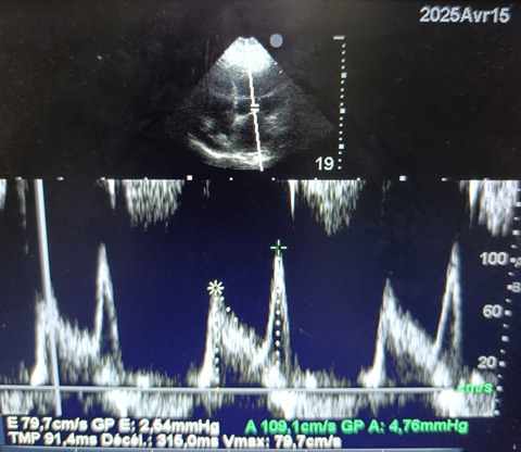 Mitral inflow Doppler profile