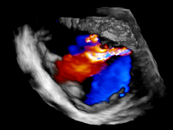 Coronary bypass and mitral repair: surgical treatment in a HFrEF patient