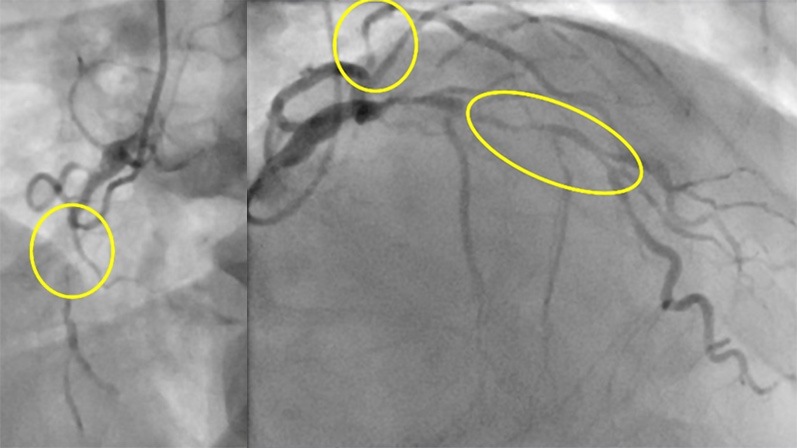 Coronary bypass and mitral repair: surgical treatment in a HFrEF patient