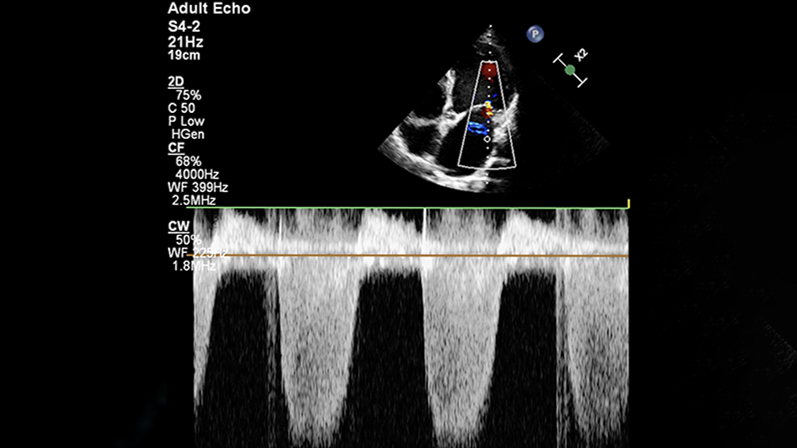 HFrEF with a Specific Cardiomyopathy: Becker Muscular Dystrophy