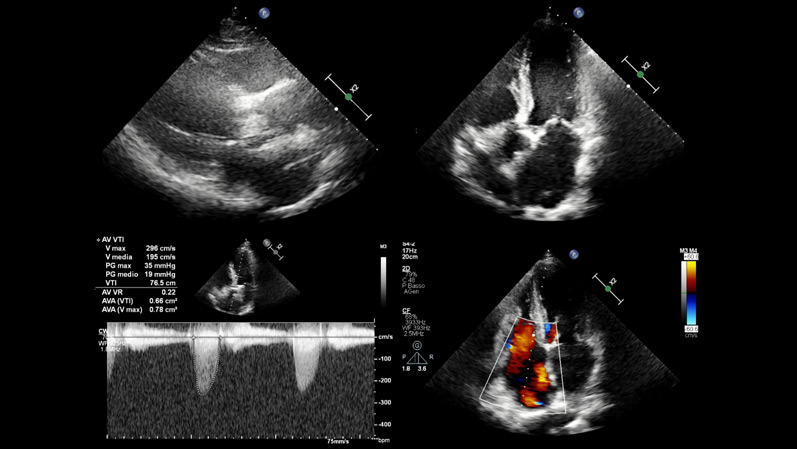 Navigating multiple valvular heart disease in a patient with heart failure