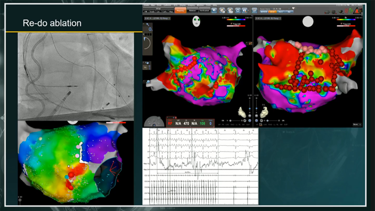 AF Ablation as the 5th pillar in HF management