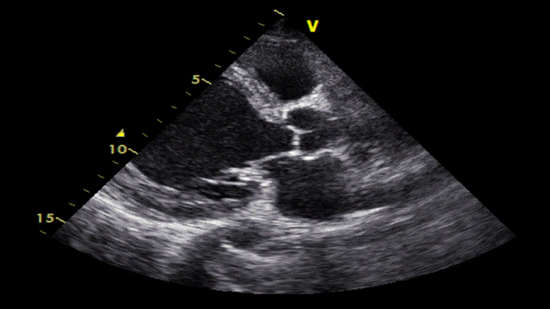 From Severe Dilated Cardiomyopathy to Cardiac Recovery