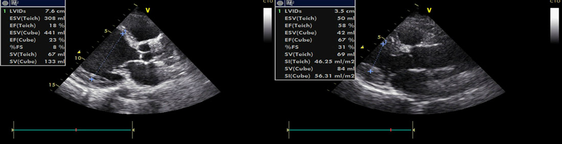 From Severe Dilated Cardiomyopathy to Cardiac Recovery: Figure 1:PLAX dimensions; baseline vs 2 yrs post–CRT-P