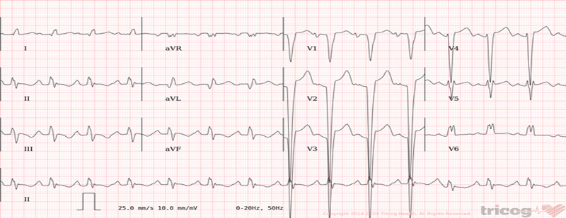 From Severe Dilated Cardiomyopathy to Cardiac Recovery: Investigations
