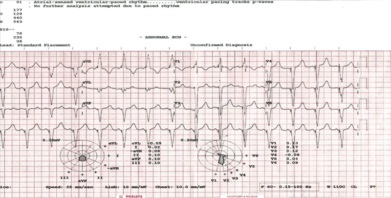 Given the persistent HF symptoms, vital signs (which likely limited GDMT full uptitration), and the presence of LBBB with QRS 170 ms, CRT implantation was directly pursued