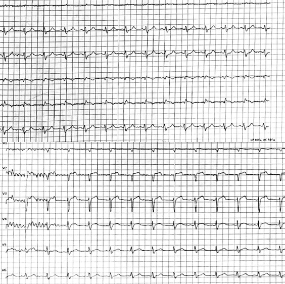 PCI, ECMO+IABP and mitral repair: interventional treatment in a HFrEF patient