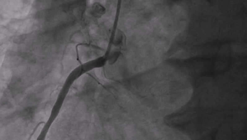 PCI, ECMO+IABP and mitral repair: interventional treatment in a HFrEF patient