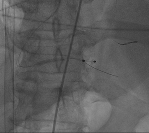 The next stage was of RCA distal part stenting.