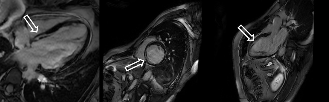 Cardiac MRI showed ischemic injury pattern with myocardial edema in the mid-basal infero-septal wall (T2 hyperintensity). 