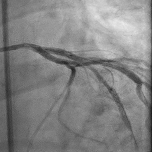 Left Anterior Descending CTO PCI