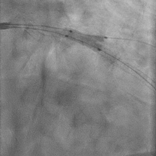 Left Anterior Descending CTO PCI