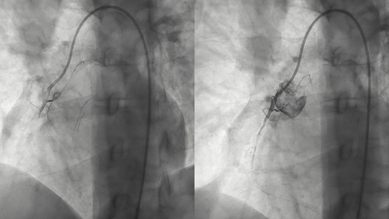 Radiation-Induced Ischemic Heart Failure with Dual CTOs in a Young Lymphoma Survivor