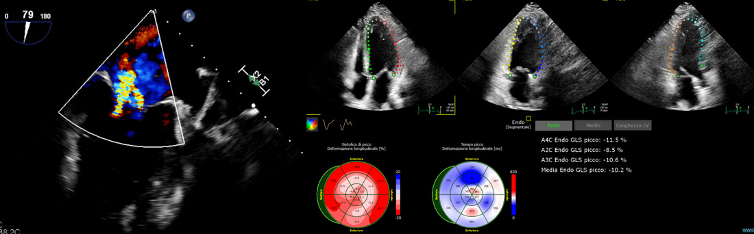 TOE: post-infarction cardiomyopathy with mildly reduced left ventricular ejection fraction (LVEF 40-43%). 