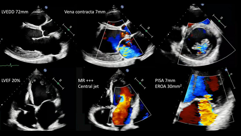 Mitral regurgitation - Finding the right time for the right patient- How soon is now?