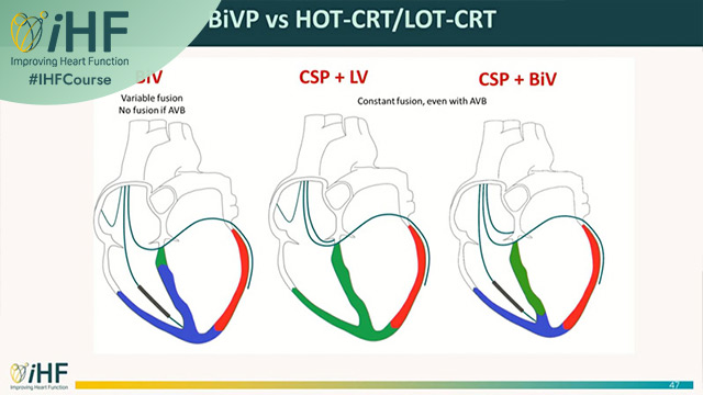 Decisions at the edge: from drug escalation to CIED implantations in atypical HFrEF