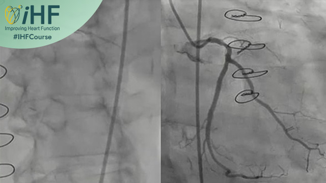High risk PCI with rotational atherectomy and mechanic circulatory support