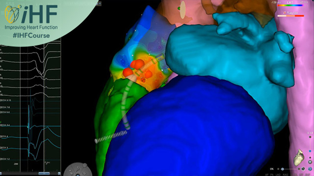 PVCs in heart failure: what to medically treat, ablate, or leave alone