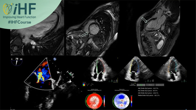 STEMI with dual CTOs in a young cancer survivor