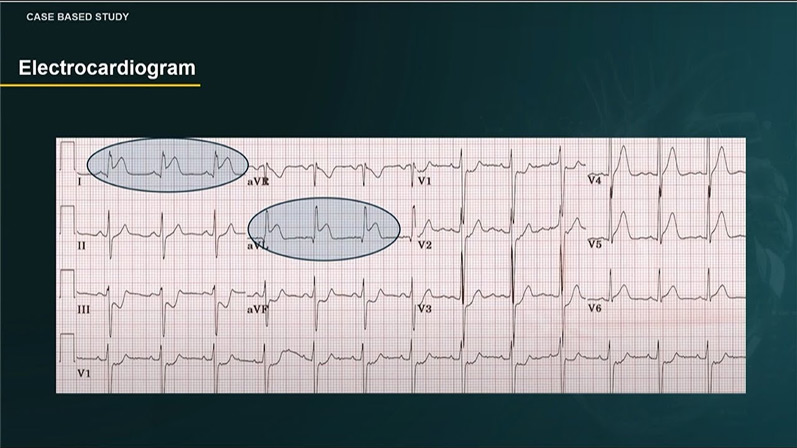 When you think that STEMI is all about primary PCI