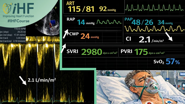 ACS with cardiogenic shock: challenging clinical settings in need of trans-disciplinary management