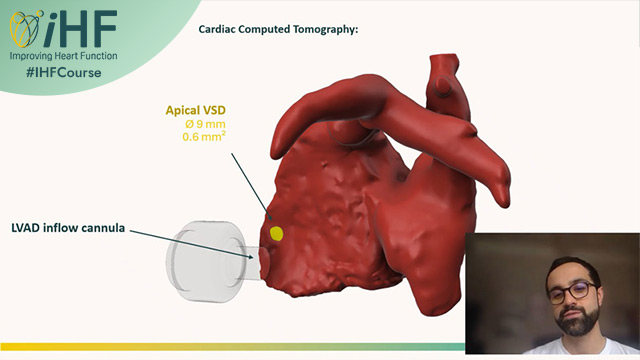 Fixing a Mechanical Heart?