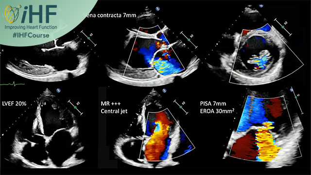 Mitral regurgitation - Finding the right time for the right patient- How soon is now?