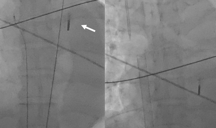 Management of ventricular septal rupture after myocardial infarction: a trans-disciplinary approach