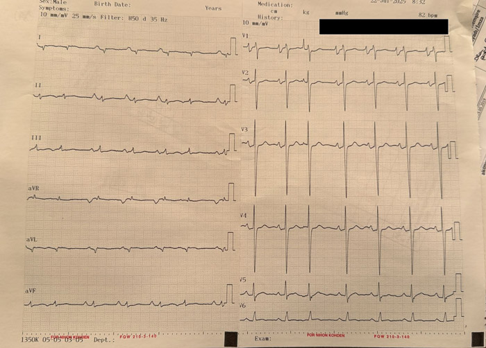 HFrEF with a Specific Cardiomyopathy: 12-lead ECG of the patient at admission
