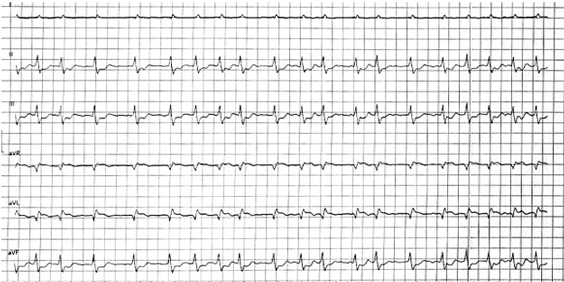 . The patient subsequently developed atrial fibrillation.