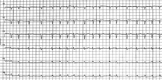 PCI, ECMO+IABP and mitral repair: interventional treatment in a HFrEF patient: The patient subsequently developed atrial fibrillation. 