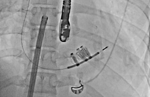 Figure 3: Three mitral clips can be seen on fluoroscopic image